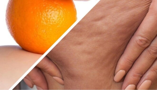 Sellülitləri yox edin